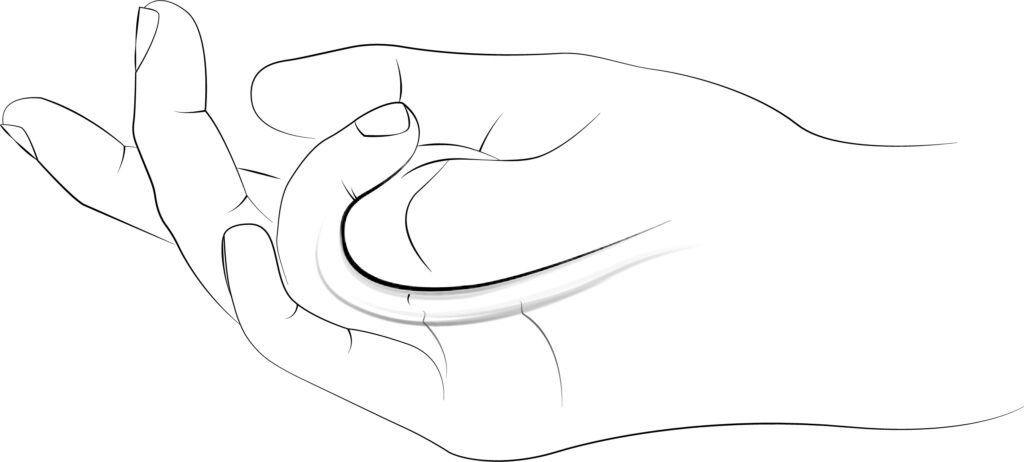 forkorte skepsis apparat Springfinger eller kuskefinger - Ergoklinikken